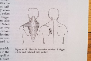 trigger points causing neck pain
